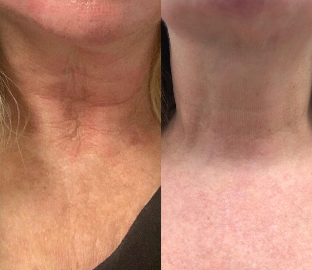 Woman's neck before and after, New Image Cosmetics, Edmonton AB
