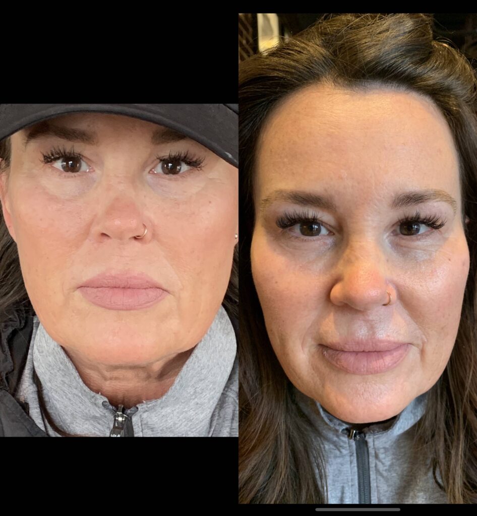 Before and 5 months after a Silhouette InstaLift® procedure.