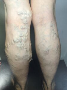 Varicose Veins Before Pictures | New Image Cosmetic