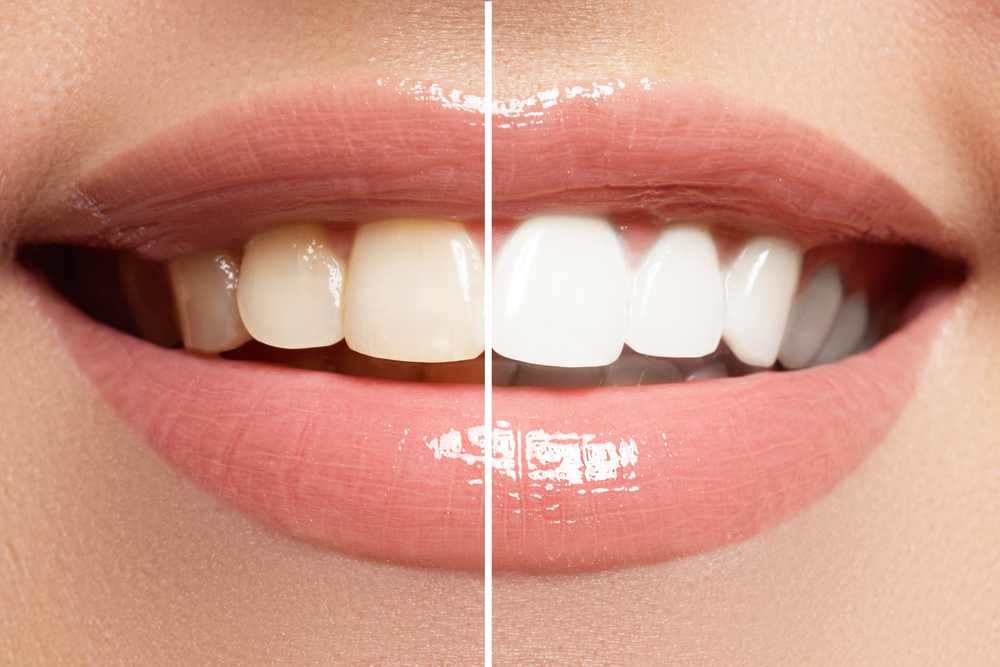 Teeth Whitening in Edmonton, Alberta | New Image Cosmetic