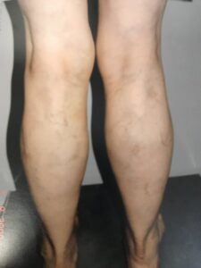 Varicose Veins Before and After Pictures | New Image Cosmetic