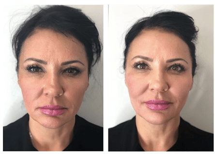 JUVÉDERM Before and After | New Image Cosmetic